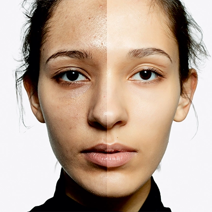 Dark Spots & Pigmentation