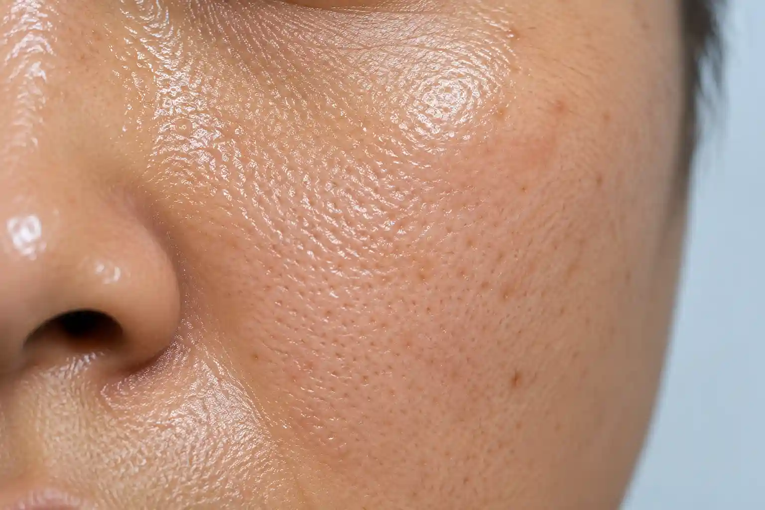 Oily Skin