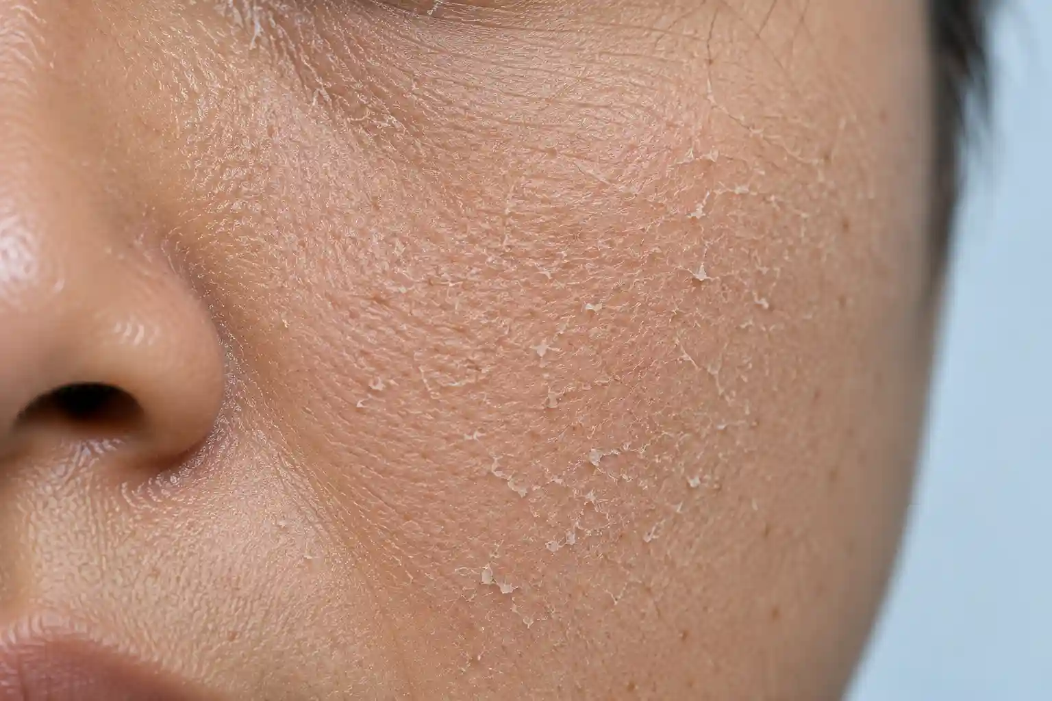 Dry Skin